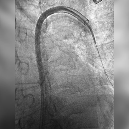 Angiogram of occluded blood vessel in the lung