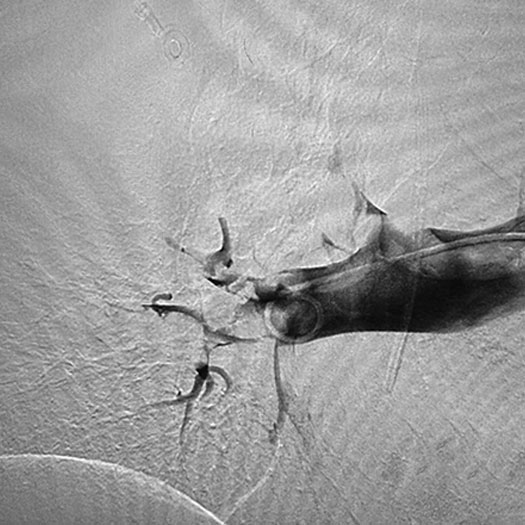 angiogram of occluded blood vessel in the lung