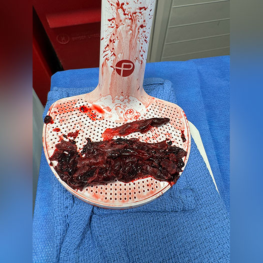 Blood Clot from Pulmonary Embolism
