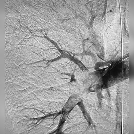 Angiogram of occluded blood vessel in the lung
