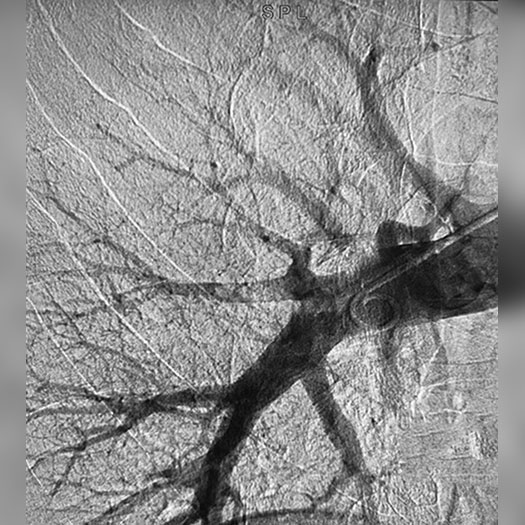 Angiogram of cleared blood vessel in a lung
