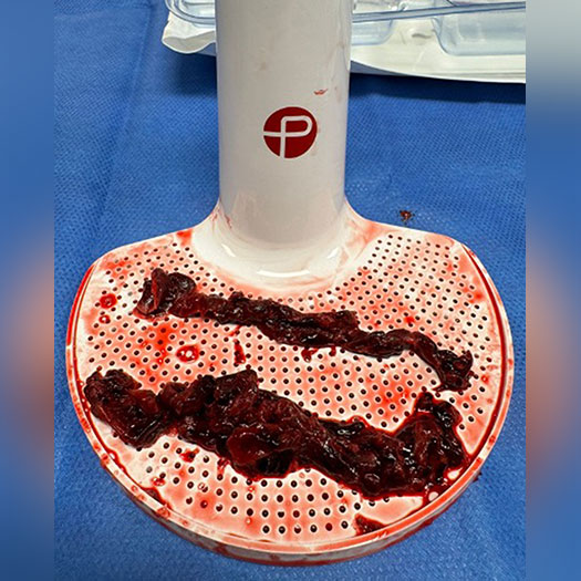 Blood Clots post thrombectomy on penumbra engine tray