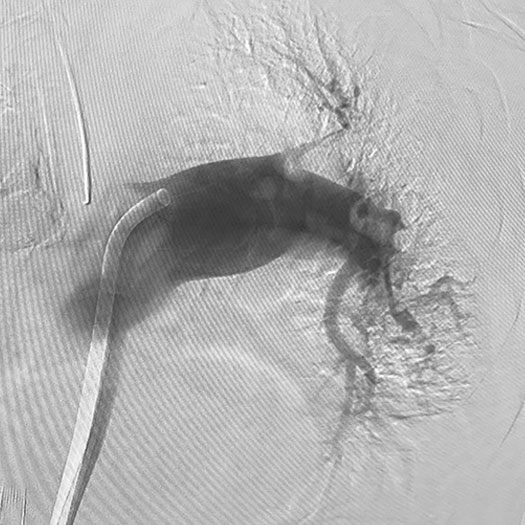 angiogram of occluded blood vessel in both the lungs