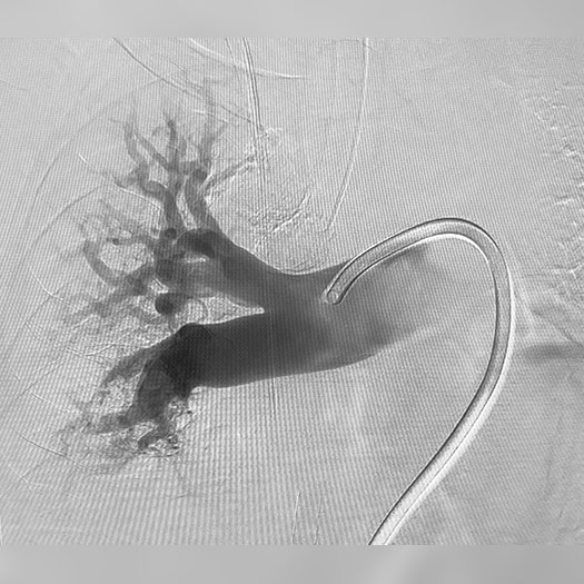 angiogram of cleared blood vessel in both the lungs