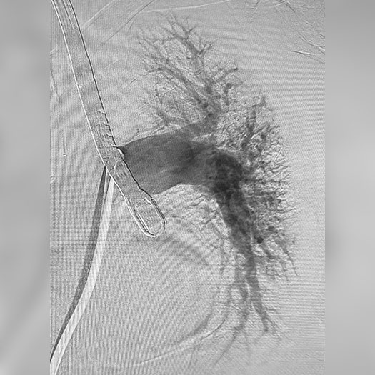 angiogram of cleared blood vessel in both the lungs