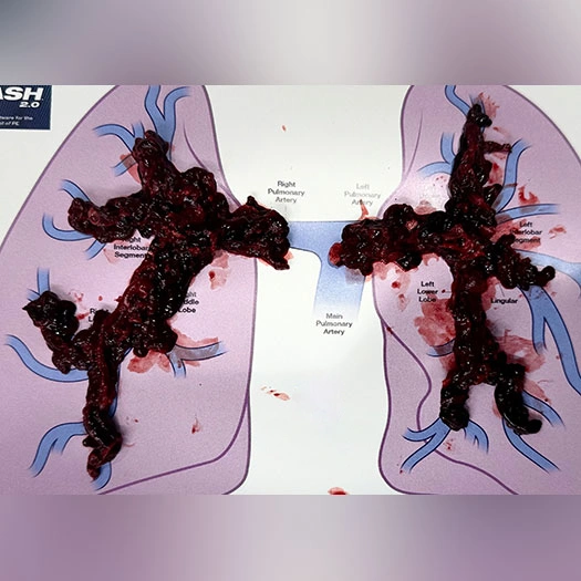 Blood Clot from Bilateral Pulmonary Embolism