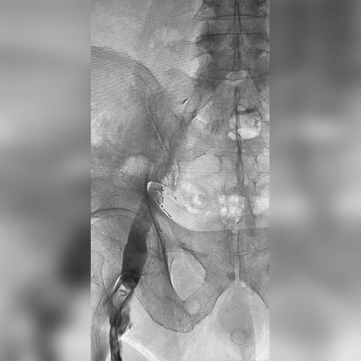 angiogram of occluded iliofemoral vein