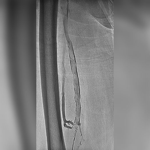 angiogram of occluded iliofemoral vein