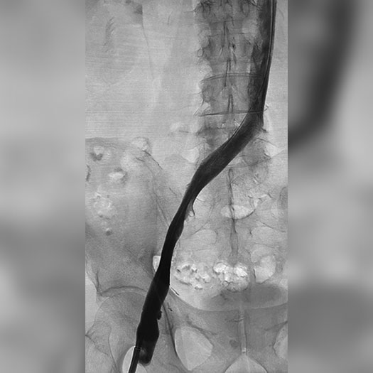 angiogram of cleared iliofemoral vein