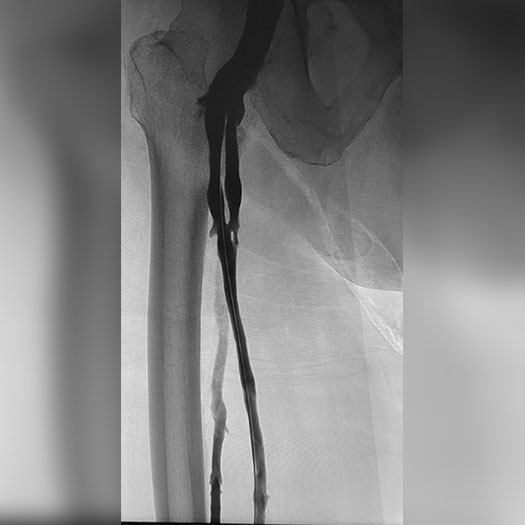 angiogram of cleared iliofemoral vein