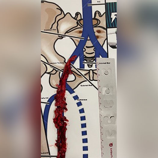 Blood Clot from Iliofemoral Vein