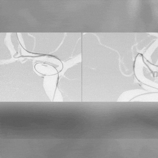 ANIMATED ANGIOGRAM OF EMBOLIZATION COILING IN A VESSEL