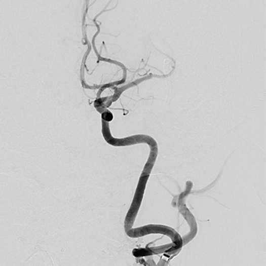 angiogram of blood vessel