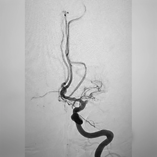 angiogram of occluded blood vessel