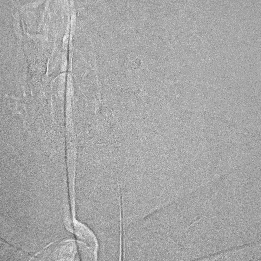 animation of catheter access tracking in blood vessel