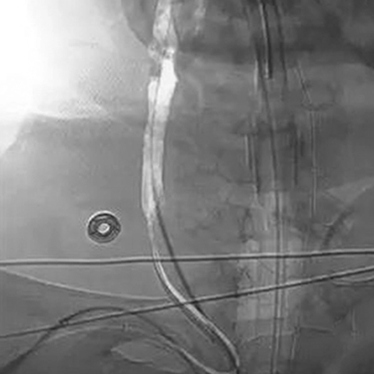 angiogram of catheter access tracking in carotid artery