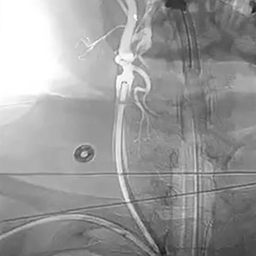 angiogram catheter access tracking in carotid artery