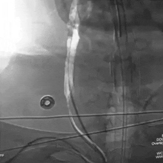 animation of catheter access tracking in carotid artery