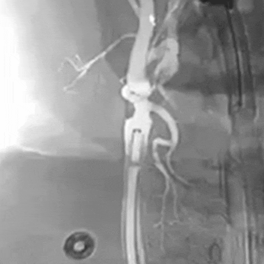 animation of catheter access tracking in carotid artery