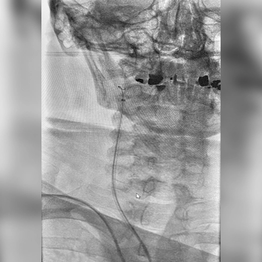 angiogram of catheter access tracking in carotid artery