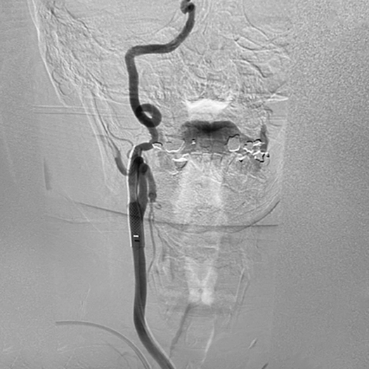 angiogram of catheter access tracking in carotid artery