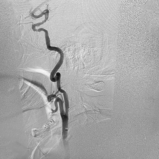 angiogram of catheter access tracking in carotid artery