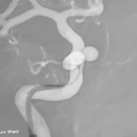 Animation of Balloon Coiling in Internal Carotid Artery