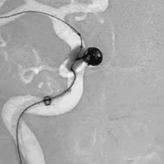 Animation of Balloon Coiling in Internal Carotid Artery