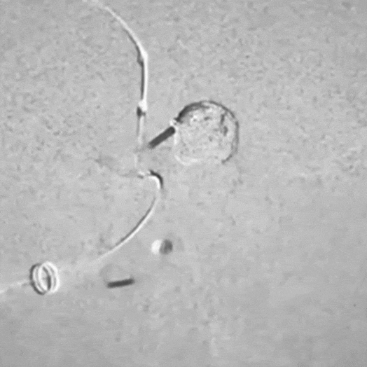 Animation of Balloon Coiling in Internal Carotid Artery
