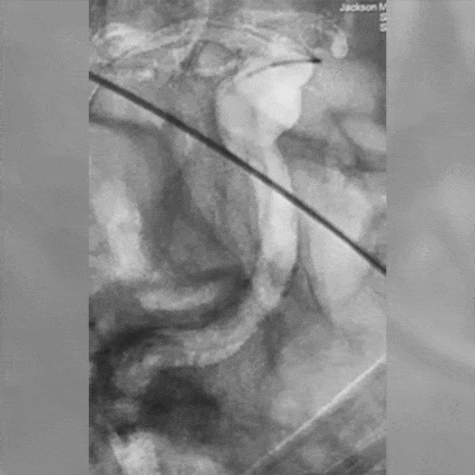 Animation of Coil Embolization within internal carotid artery