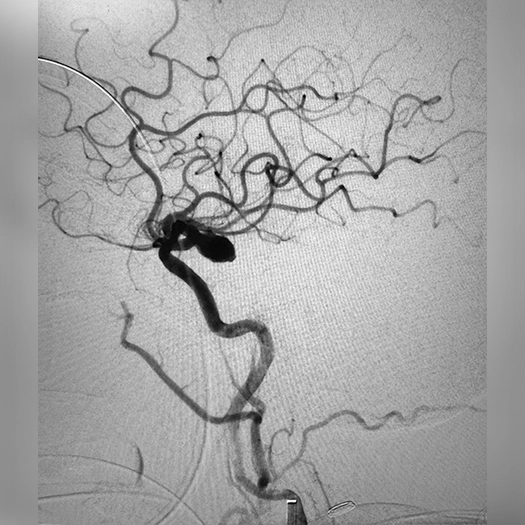Angiogram of tracking catheter to aneurysm in carotid artery