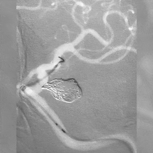Animation of Coil Embolization within internal carotid artery