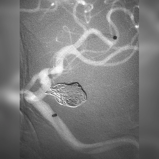 Angiogram of coil embolization carotid artery
