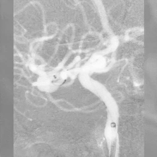 Animation of Coil Embolization within Middle Cerebral Artery