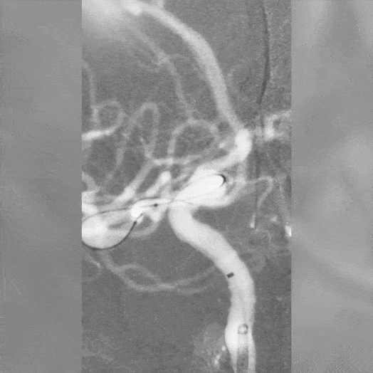 Animation of Coil Embolization within Middle Cerebral Artery