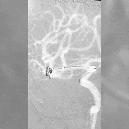 Animation of Coil Embolization within Middle Cerebral Artery