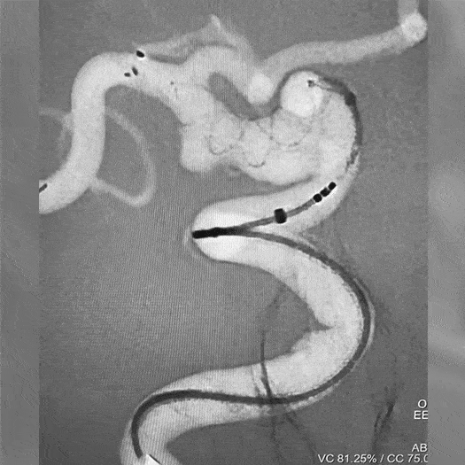 Animation of Coil Embolization deployment within internal carotid artery