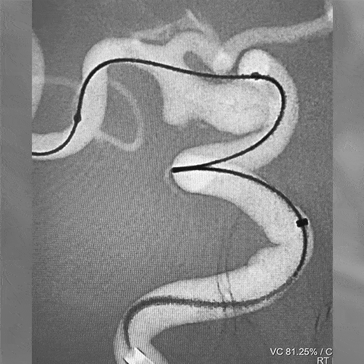 Animation of Coil Embolization deployment tracked within internal carotid artery