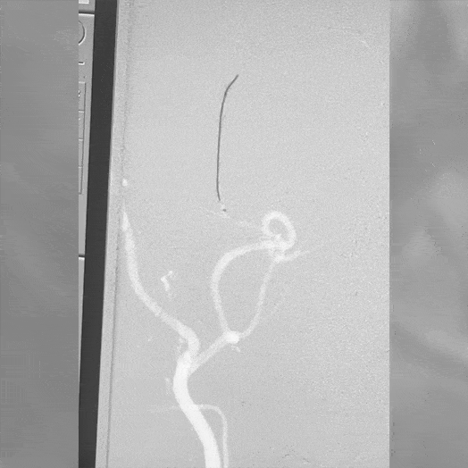 Animation of Coil Embolization within Middle Meningeal Artery
