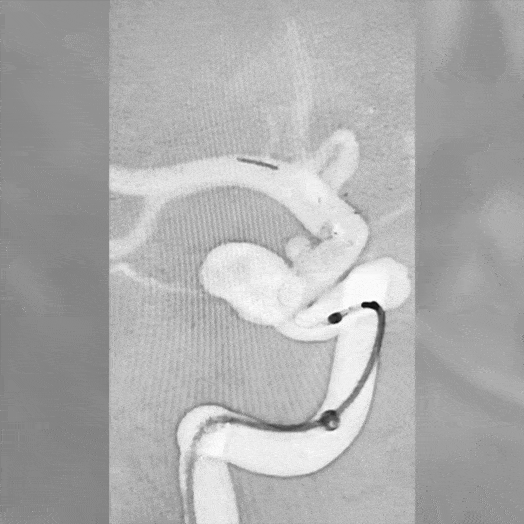 Animation of Coil Embolization within the internal carotid artery