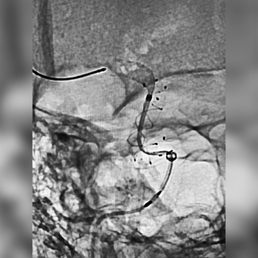 Angiogram of Coil Embolization within internal carotid artery