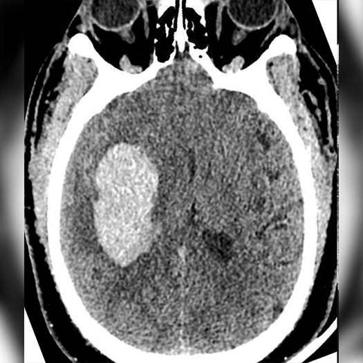 angiogram of a brain with a mass