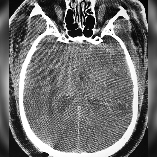angiogram of a brain post-neuroevacuation
