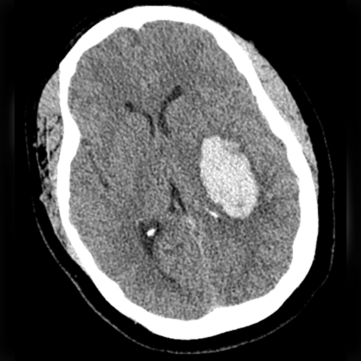 angiogram of a brain with a mass