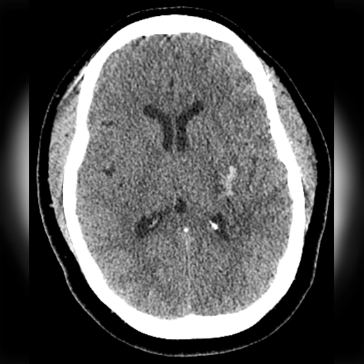 angiogram of a brain post-neuroevacuation