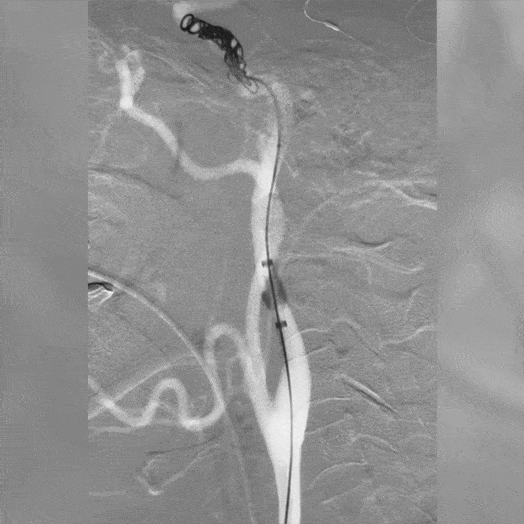 Animation of embolization coils being placed and 2 POD400 Coils, 14 PAC400 Coils, 1 PC400 Complex Coil