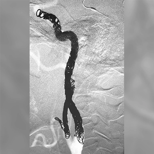 Angiogram of embolization coils in a vessel and 2 POD400 Coils, 14 PAC400 Coils, 1 PC400 Complex Coil