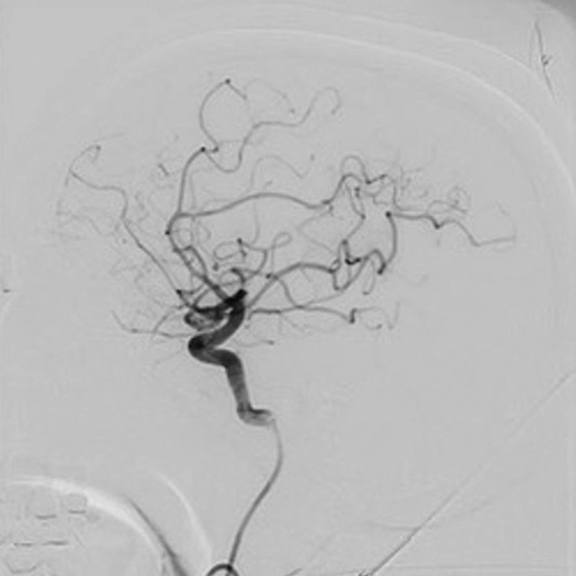 angiogram of occluded blood vessel