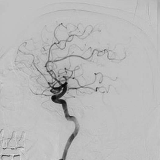 angiogram of cleared blood vessel