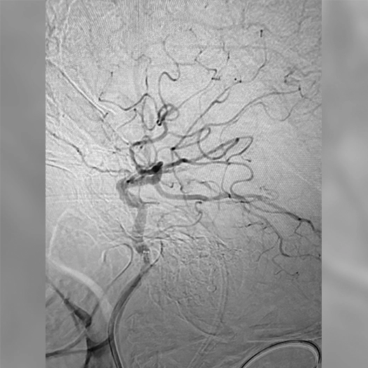 angiogram of occluded blood vessel